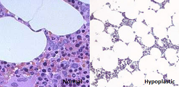 stachybotrys disease- blood