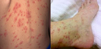 stachybotrys disease - skin